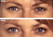 Botox  uygulamaları