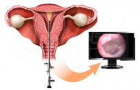 Tüp bebekte gebeliği arttıran ilginç bir yöntem: histeroskopik endometrial hasarlama