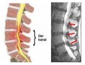 Omurilik kanalında daralma (spinal stenoz)