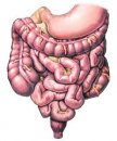 Ülseratif kolit ve crohn hastalığı