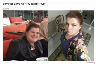 Obezitede cerrahi yöntem