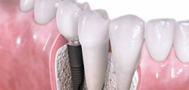 Dental implant nedir ?