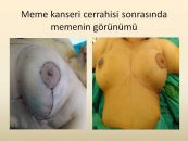 Meme kanserine estetik çözüm; onkoplastik cerrahi