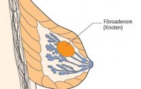 Fibroadenomlar