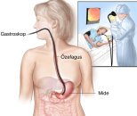 Gastroskopi işlem riskleri