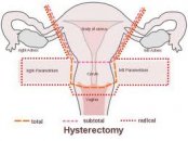 Histeroktomi
