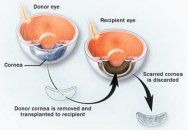 Göz transplantasyonu nedir ?