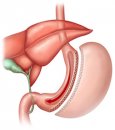 Tüp mide ameliyatı – sleeve gastrectomy