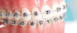 Ortodonti, diğer adıyla tel tedavisi nasıl yapılır?