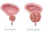 Prostat biyopsisi nedir?