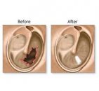 Kulak zarı onarılması (timpanoplasti)