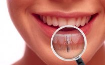 Dental (diş ) impantlar nedir?