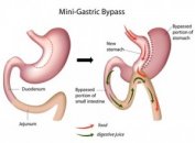 Mini gastric bypass ameliyatı