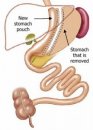 Tüp mide ameliyatı nasıl etki eder?