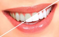 Bleaching (diş beyazlatma) işlemi