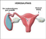 Hidrosalpinks