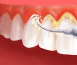 Diş bakımı; dişleri temizletmek zararlı mıdır?