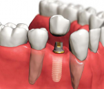 İmplantoloji ve çene implantları hakkında sık sorulan sorular