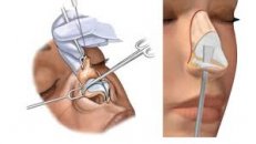 Rinoplasti (burun estetiği) ameliyatından sonra dikkat edilmesi gerekli noktalar
