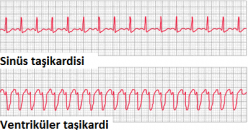 Çocuklarda çarpıntı olur mu?