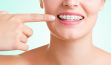 Şeffaf diş teli tedavisi