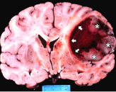 Kötü huylu beyin tümörleri