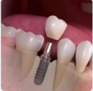 Implant (vidalı) diş