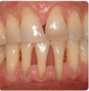 Diş eti çekilmesi, diş eti kanaması (periodontoloji)