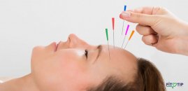 Migren tedavisinde akupunkturun yeri