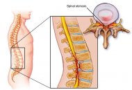 Mikrocerrahi teknikle omurga kanal daralması hastalığı tedavisi