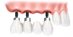 Kısaca dental implant