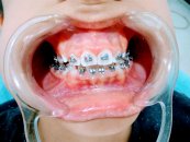 Ortodontik bozukluk nedenleri