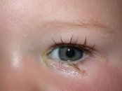 Bebeklerde göz sulanması, doğumsal göz yaşı kanal tıkanıklığı
