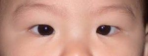 Bebeklik çağı göz kaymaları tipleri nelerdir? yalancı şaşılık nedir?