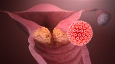 Hpv( human papilloma virüs) enfeksiyonu ve korunma