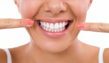 Diş beyazlatma (bleaching) ile ilgili en çok sorulan sorular