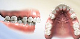 Ortodontik tedavi için diş çekimi