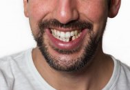 Diş eksikliğinin sağlığınız üzerinde etkisi