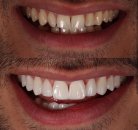 Zirkonyum diş nedir ? gülüş estetiği nasıl sağlanır ?