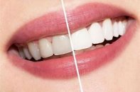 Diş beyazlatma / bleaching işlemi