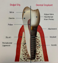 Eksik diş ve diişlerin yerine implant