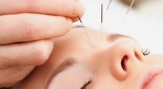 Sağlığınız için doğal yöntemlerden; akupunktur