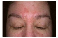 Sık görülen bir deri hastalığı: seboreik dermatit!