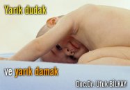 Yarık dudak ve yarık damak