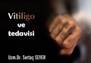 Vitiligo ve tedavisi