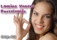 Lamine veneer porselenler