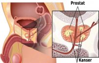 Prostat hastalığı