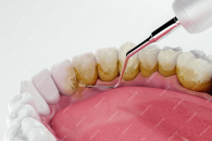 Diş taşı temizliği zararlı mı? diş mineme zarar verir mi ?
