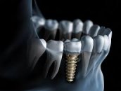 Diş implantları !