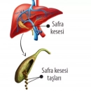 Safra kesesi taşının tedavi yöntemi cerrahidir!